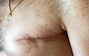 male mastectomy