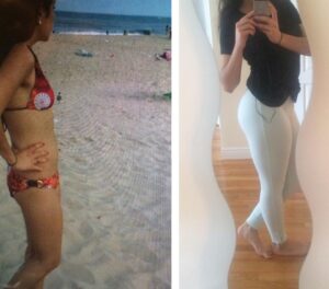 Ashley Before & After Treatment